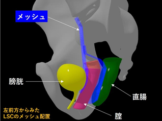 腹腔鏡下仙骨腟固定術｜泌尿器科｜上尾中央総合病院