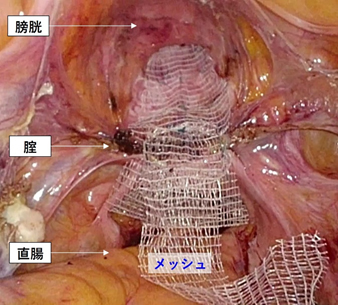 腹腔鏡下仙骨腟固定術｜泌尿器科｜上尾中央総合病院