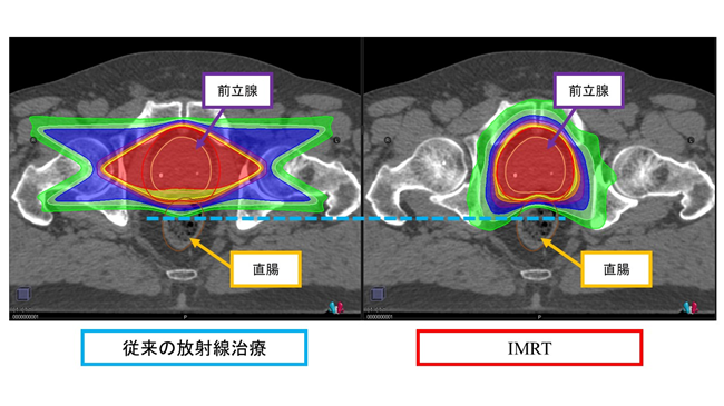 IMRT(強度変調放射線治療)の導入